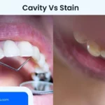 Cavity VS Stain